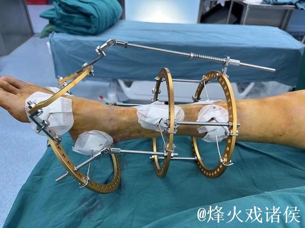 拜仁中场托利索接受脚踝手术 拜仁中场托利索接受脚踝手术