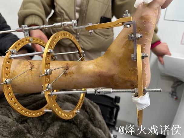 拜仁中场托利索接受脚踝手术 拜仁中场托利索接受脚踝手术